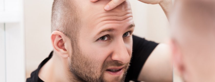 A balding man contemplating hair replacement.