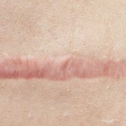 scars can be treat by scars repair doctor