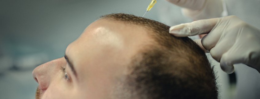 Acell prp hair growth injection therapy