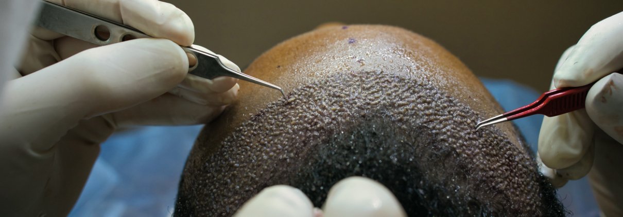 Doctor Operating Hair replacement surgery