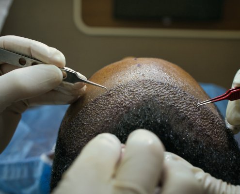 Doctor Operating Hair replacement surgery