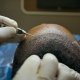 Doctor Operating Hair replacement surgery