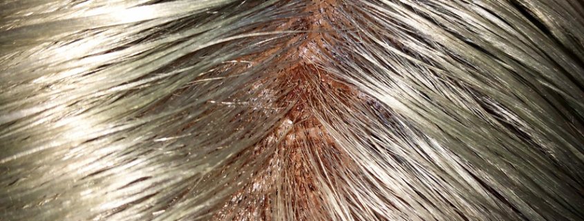 Scalp Scars repair