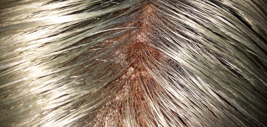 Scalp Scars repair