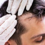 Hair Doctor Analysing Patients haIr problem