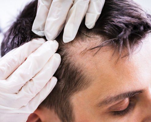 Hair Doctor Analysing Patients haIr problem