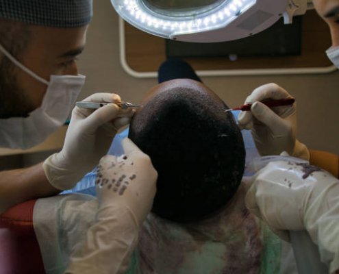 Hair Transplant