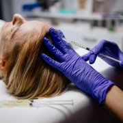 PRP (platelet-rich plasma) therapy for hair loss