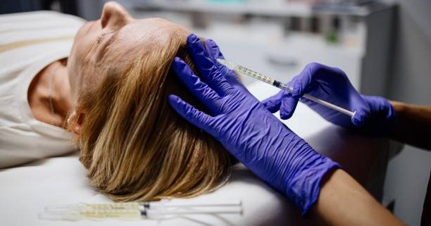 PRP (platelet-rich plasma) therapy for hair loss