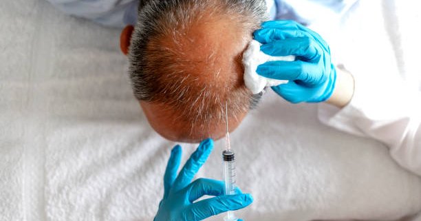 Man with hair loss problem receiving injection in head by young female doctor. Treatment of baldness with beauty injection. Man with hair loss problem receiving injection on white background, close up