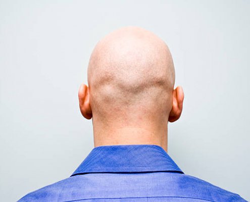 Man stands in a blue shirt facing a light blue wall showing his bald head at the camera