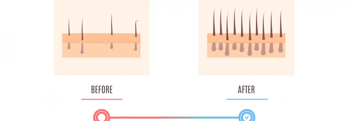 Scalp skin cross section diagram showing hair restoration result