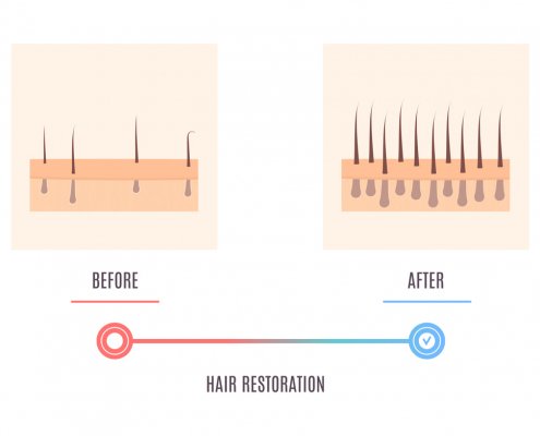 Scalp skin cross section diagram showing hair restoration result